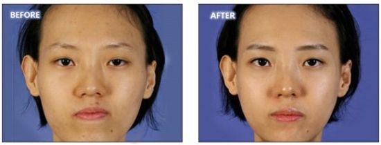 女性不對稱下頜角整形緩解好嗎