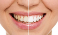 做一次冷光美白牙齒需要多少錢