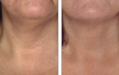 電波l皮有副作用嗎