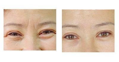 做電波l皮除皺很貴嗎