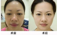 嘴巴大怎么變小