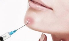 玻尿酸隆下巴要多少錢