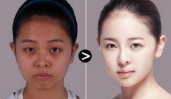 做光子嫩膚對皮膚傷害大嗎