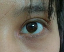 眼部疤痕整形手術(shù)注意事項