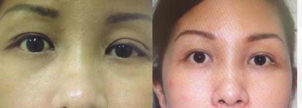 眼部疤痕整形修復(fù)前后的注意事項(xiàng)有哪些