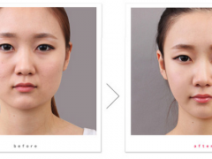 假體隆下巴后可以游泳嗎