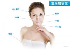 玻尿酸填下巴能保持多久 術(shù)后如何護(hù)理