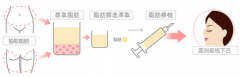 自體脂肪豐下巴的手術(shù)過程是怎樣的 多久能恢復(fù)