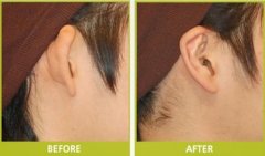 招風(fēng)耳矯正后多久可以恢復(fù)