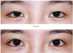 雙眼皮整形失敗修復(fù)術(shù)注意事項