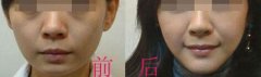 玻尿酸隆下巴有哪些優(yōu)勢