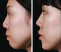 隆下巴的假體需要取出嗎