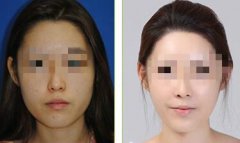 下頜角整形大概多少錢 下頜角整形大概多少錢