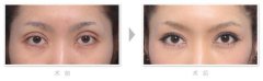 眼部整形美容手術(shù)失敗修復(fù)對比圖