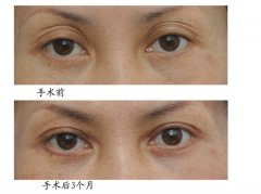 雙眼皮手術(shù)失敗修復(fù)對比圖