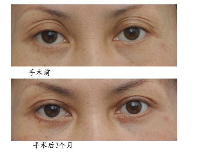 雙眼皮手術(shù)失敗修復(fù)對(duì)比圖