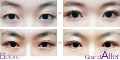 雙眼皮修復(fù)手術(shù)適應(yīng)癥