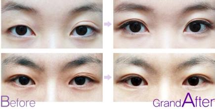 雙眼皮修復(fù)手術(shù)適應(yīng)癥