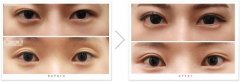 修復(fù)失敗雙眼皮的方法