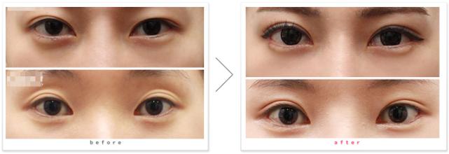 修復(fù)失敗雙眼皮的方法