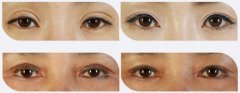 雙眼皮失敗修復(fù)對比圖片
