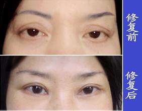 割雙眼皮失敗手術(shù)修復(fù)方法