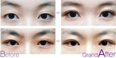 雙眼皮修復(fù)手術(shù)果前后對比圖片