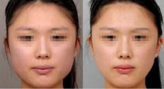 注射注射瘦臉瘦臉果怎么樣