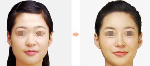 注射瘦臉B****多久打一次