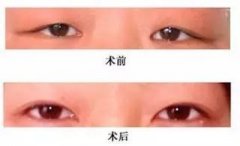 修復(fù)雙眼皮失敗有幾種方法