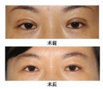 雙眼皮失敗后修復(fù)的方法有哪些