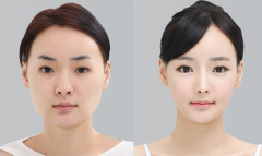 下頜角整形的恢復(fù)期長嗎 下頜角整形的恢復(fù)期長嗎