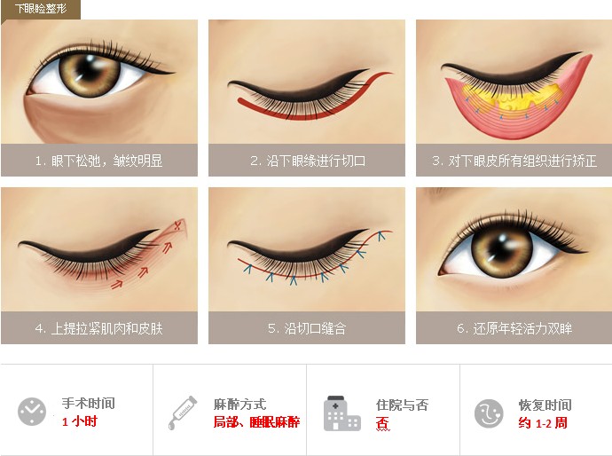 提眉術(shù),切眉術(shù),有什么,區(qū)別