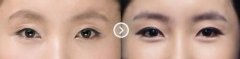 三眼皮怎么修復(fù)