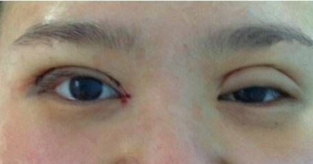 做雙眼皮失敗的圖片