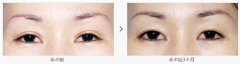 雙眼皮手術(shù)修復(fù)前后對比圖片