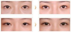 雙眼皮修復(fù)手術(shù)果圖