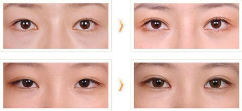 雙眼皮修復(fù)手術(shù)果圖