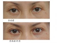修復失敗雙眼皮手術要怎么做