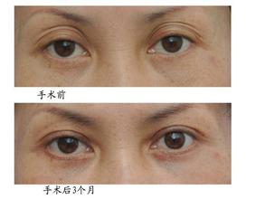 修復(fù)失敗雙眼皮手術(shù)要怎么做