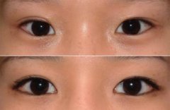 雙眼皮失敗修復優(yōu)勢