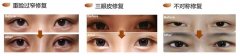 雙眼皮失敗修復對比照片