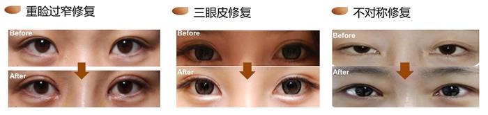 雙眼皮失敗修復(fù)對比照片