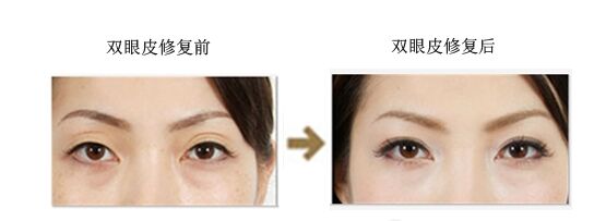 修復(fù)失敗雙眼皮方法