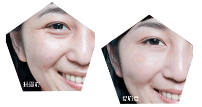 提眉切眉術(shù)前的注意事項