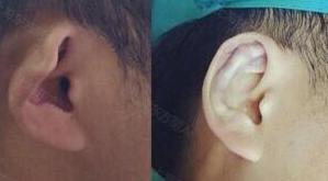 招風(fēng)耳矯正,方式,有哪些