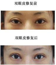 失敗眼部整形美容手術(shù)修復(fù)