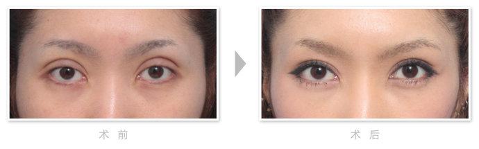 失敗眼部整形美容手術(shù)修復(fù)