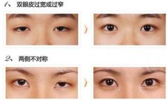 修復失敗眼部整形美容手術