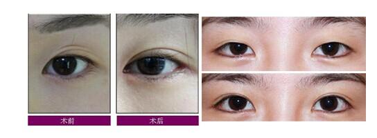 修復(fù)失敗眼部整形美容手術(shù)